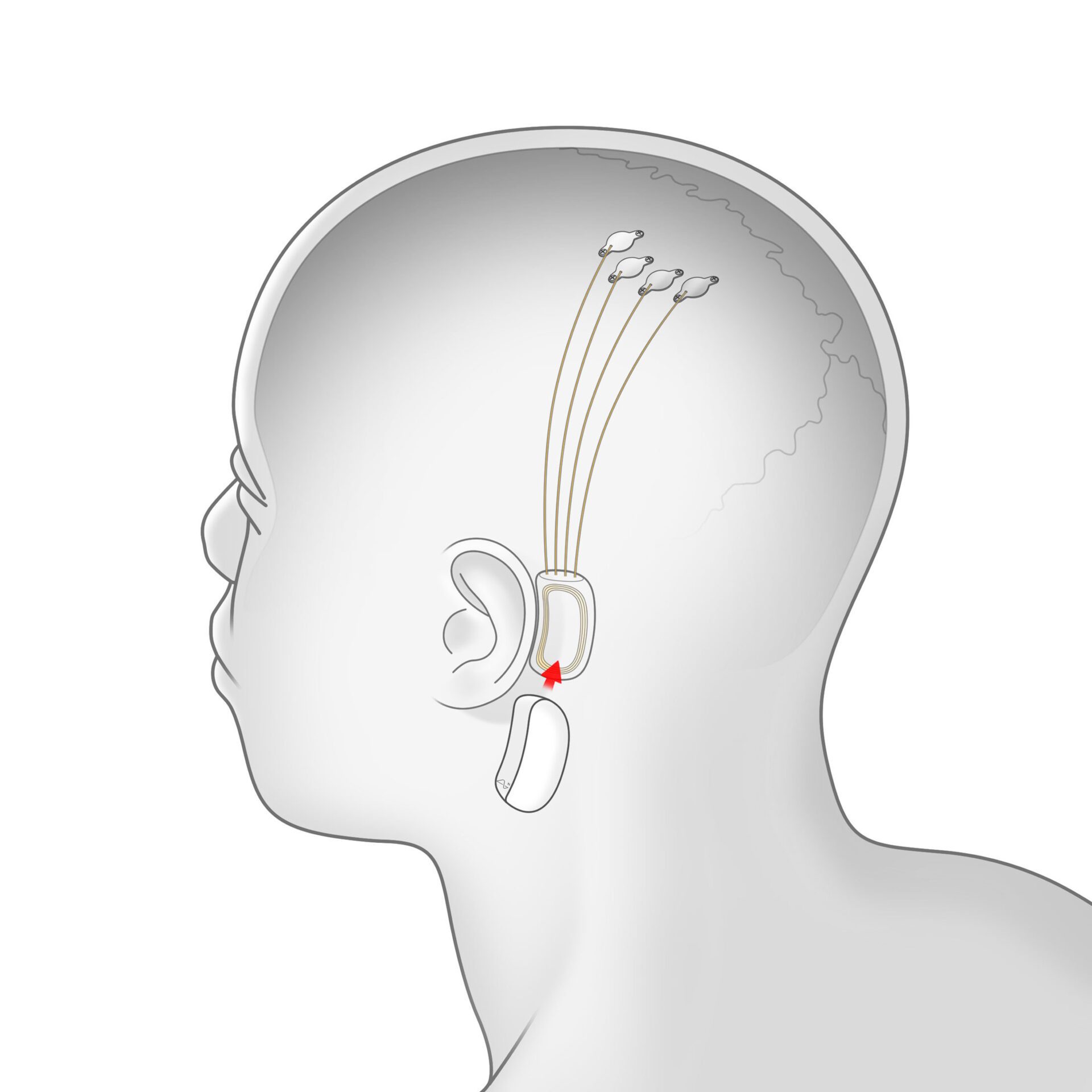 Le dispositif de Neuralink nécessite d'implanter le dispositif dans le cerveau du patient et de placer un boîtier sous l'oreille pour transmettre les informations à un ordinateur.
