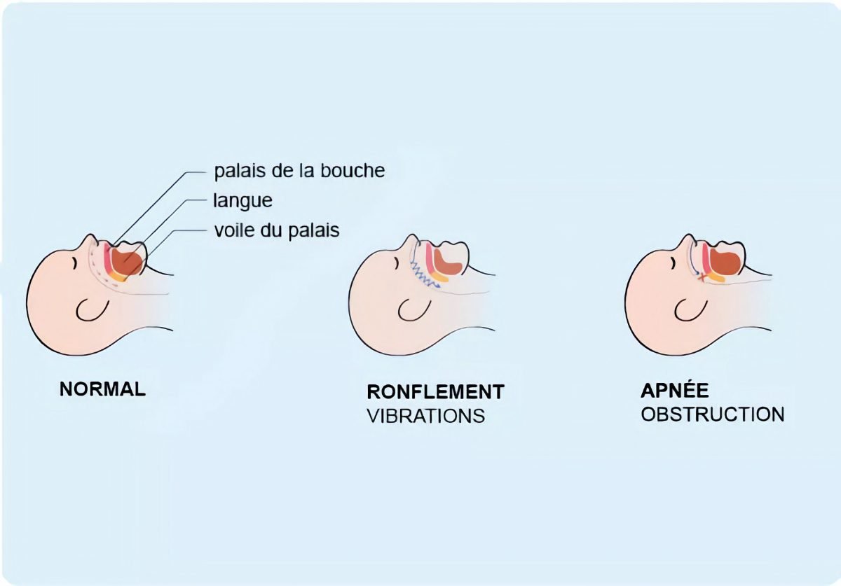 Apnée Du Sommeil